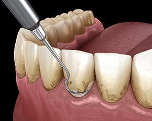 Scaling and root planing removes bacteria from the gums and teeth