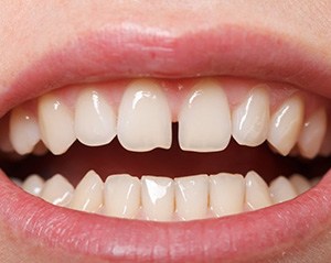 Gaps Between Teeth