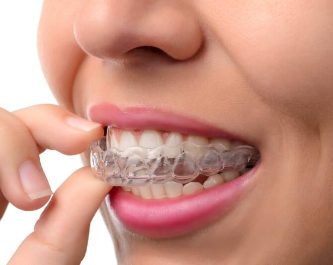 close up of a woman trying on invisalign